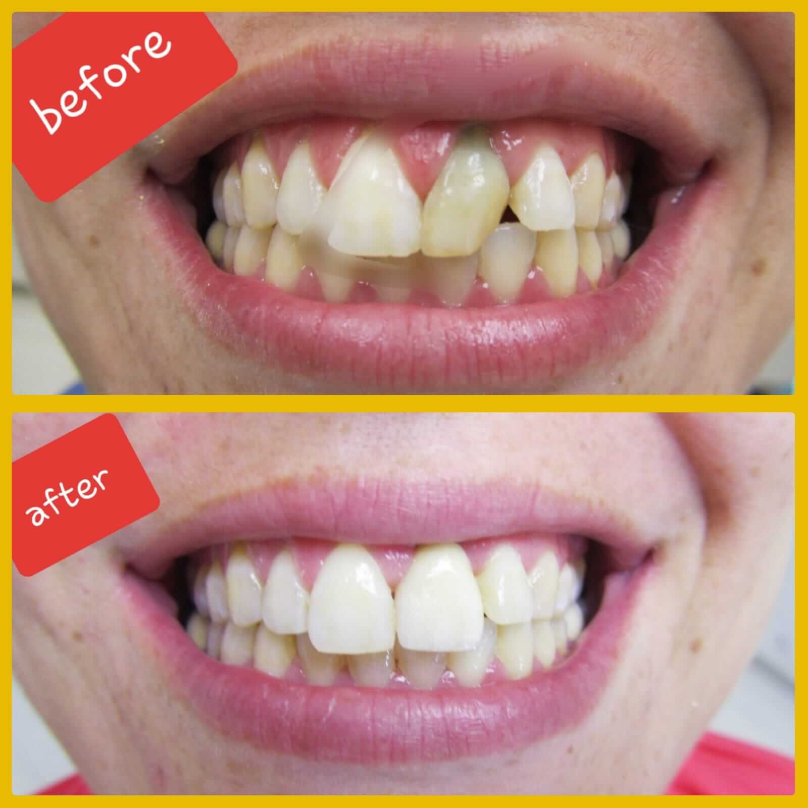 טיפול שיניים לפני ואחרי