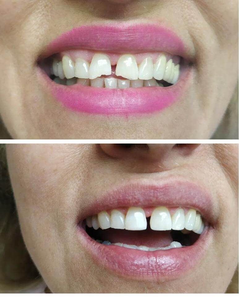 טיפול שיניים לפני ואחרי