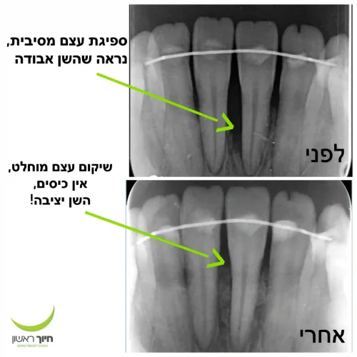 טיפול חניכיים ע"י של ד״ר אלון דוידזון - פריודונט, מומחה חניכיים במרפאתנו.